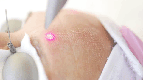 Laser Fotona : la révolution des technologies esthétiques!