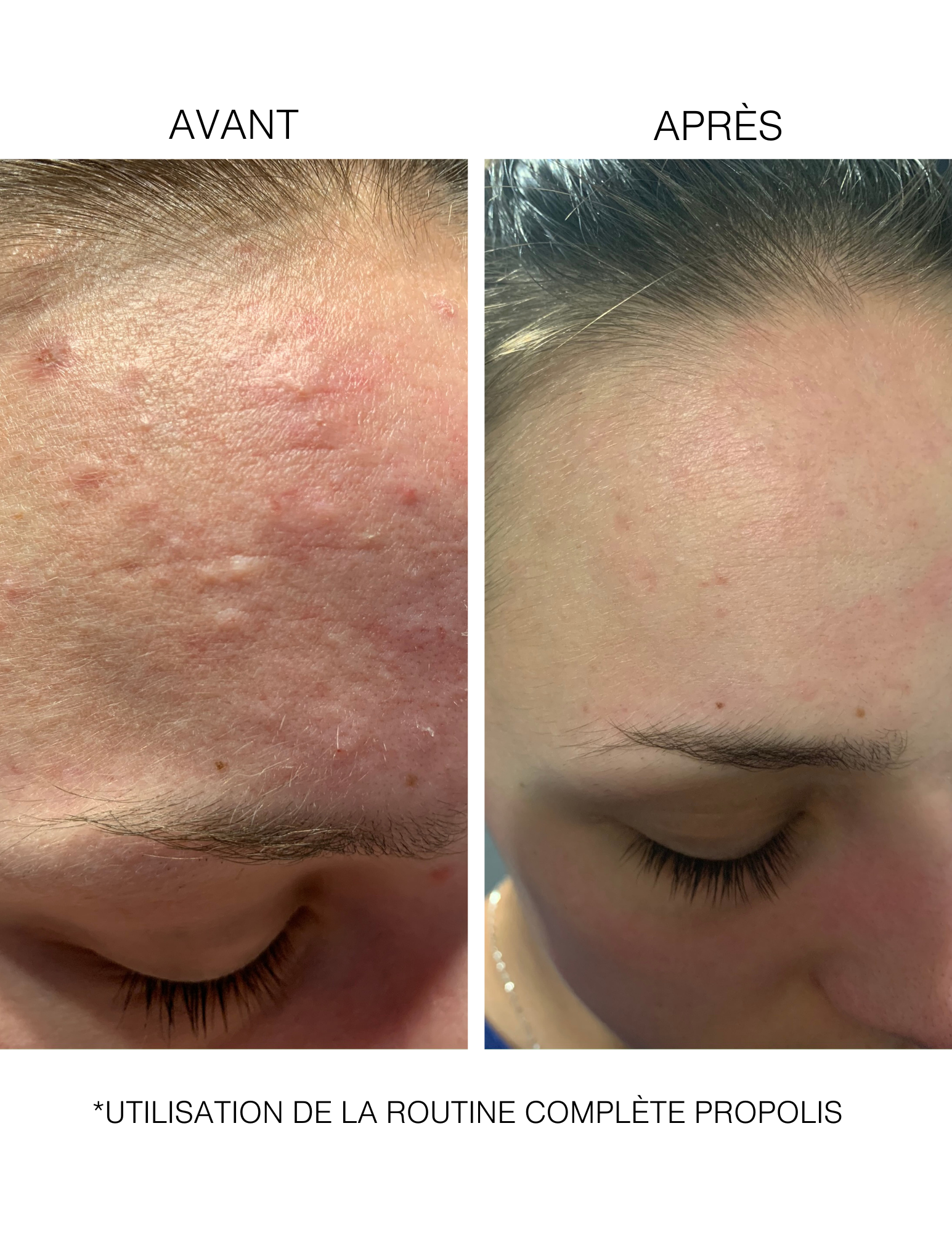 Intensive Propolis : Routine traitante pour peaux mixtes à grasses et irrégularités