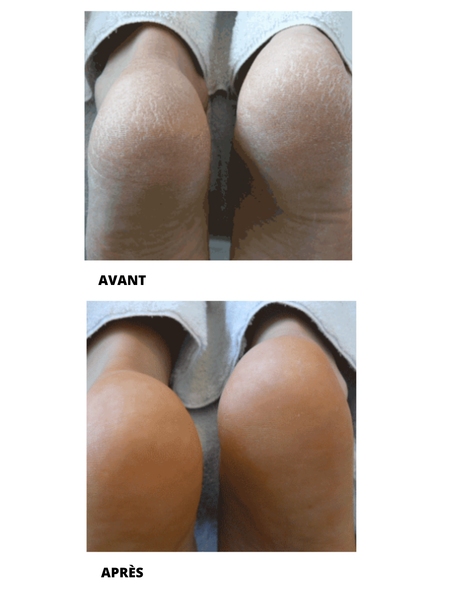 Mousse peau très sèche